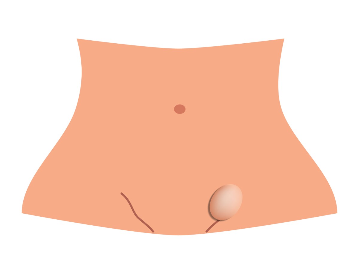Hérnia inguinal